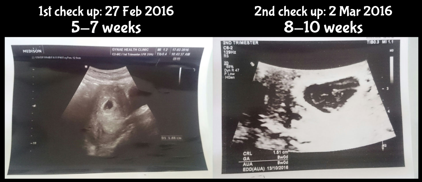 5-8-weeks-baby-ultrasound-scan