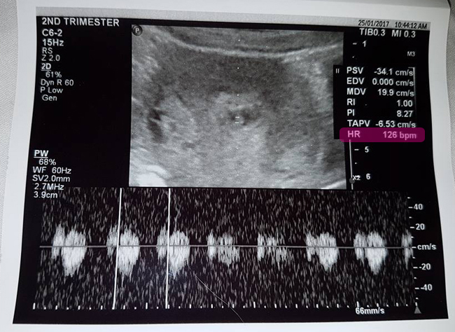 Slow Fetus Growth & Small Gestational Sac: End of my pregnancy